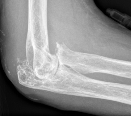 Elbow Pain 2